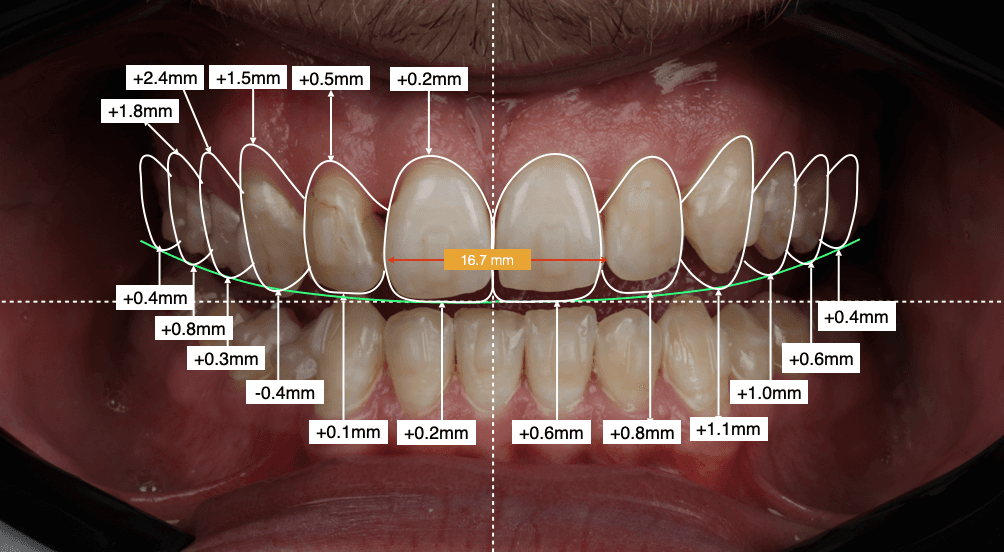 Detailed smile design mapping on teeth