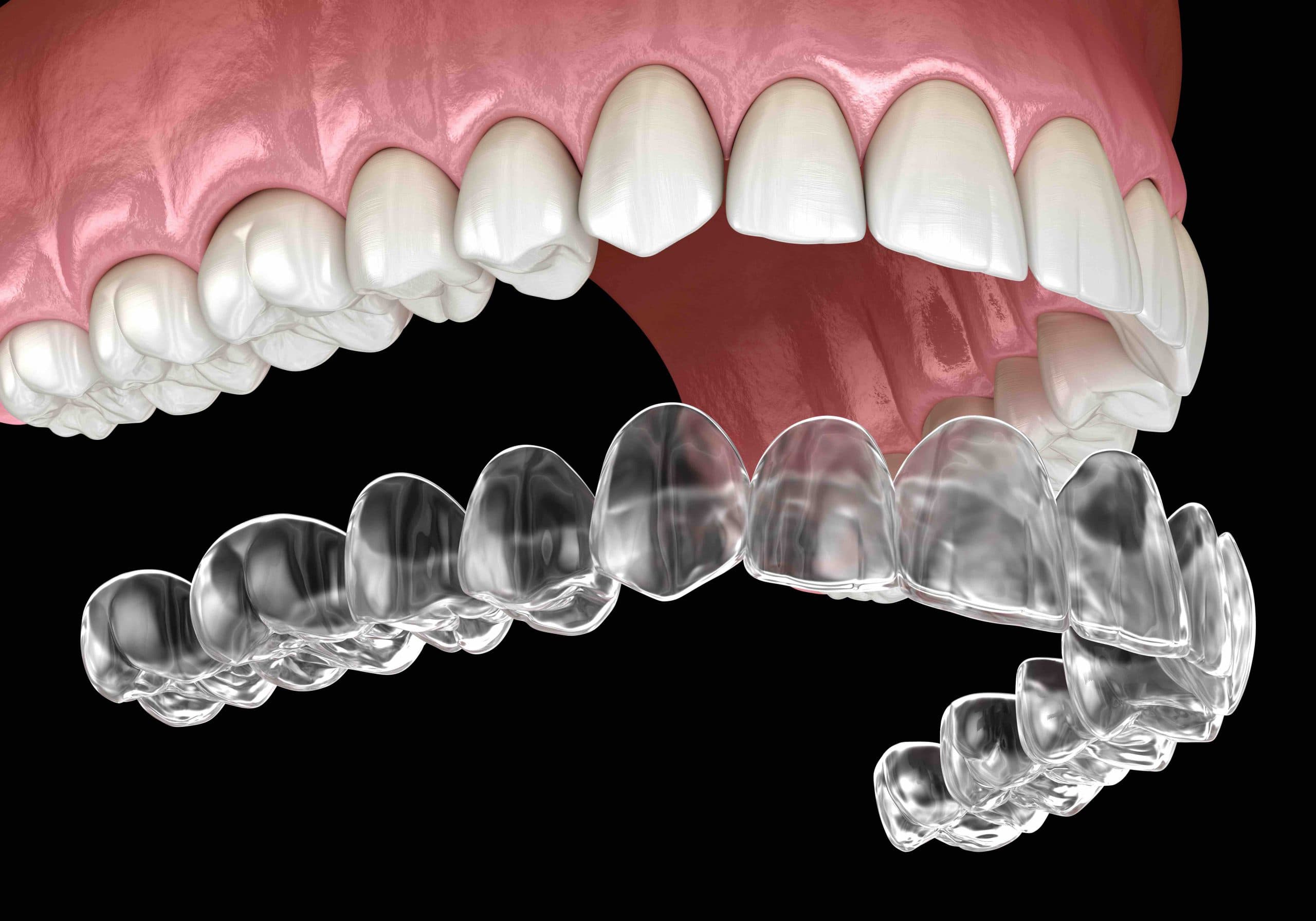 Clear aligners displayed below upper teeth