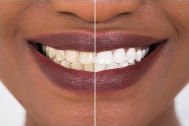 Before and after teeth whitening result
